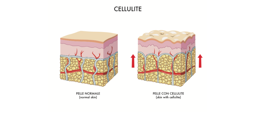 cellulit elleni diéta mi okozza a lupusos betegek fogyását