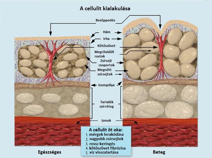 cellulit-kialakulasa