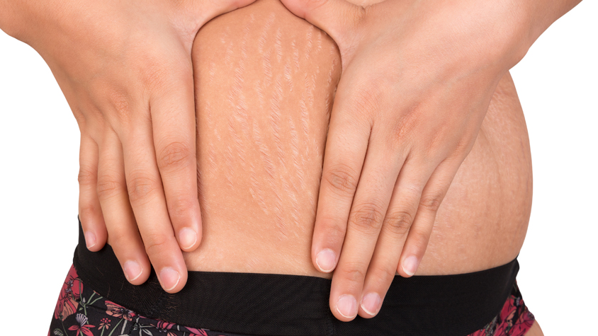 Fogyókúra: hogyan maradhat feszes a bőrünk?